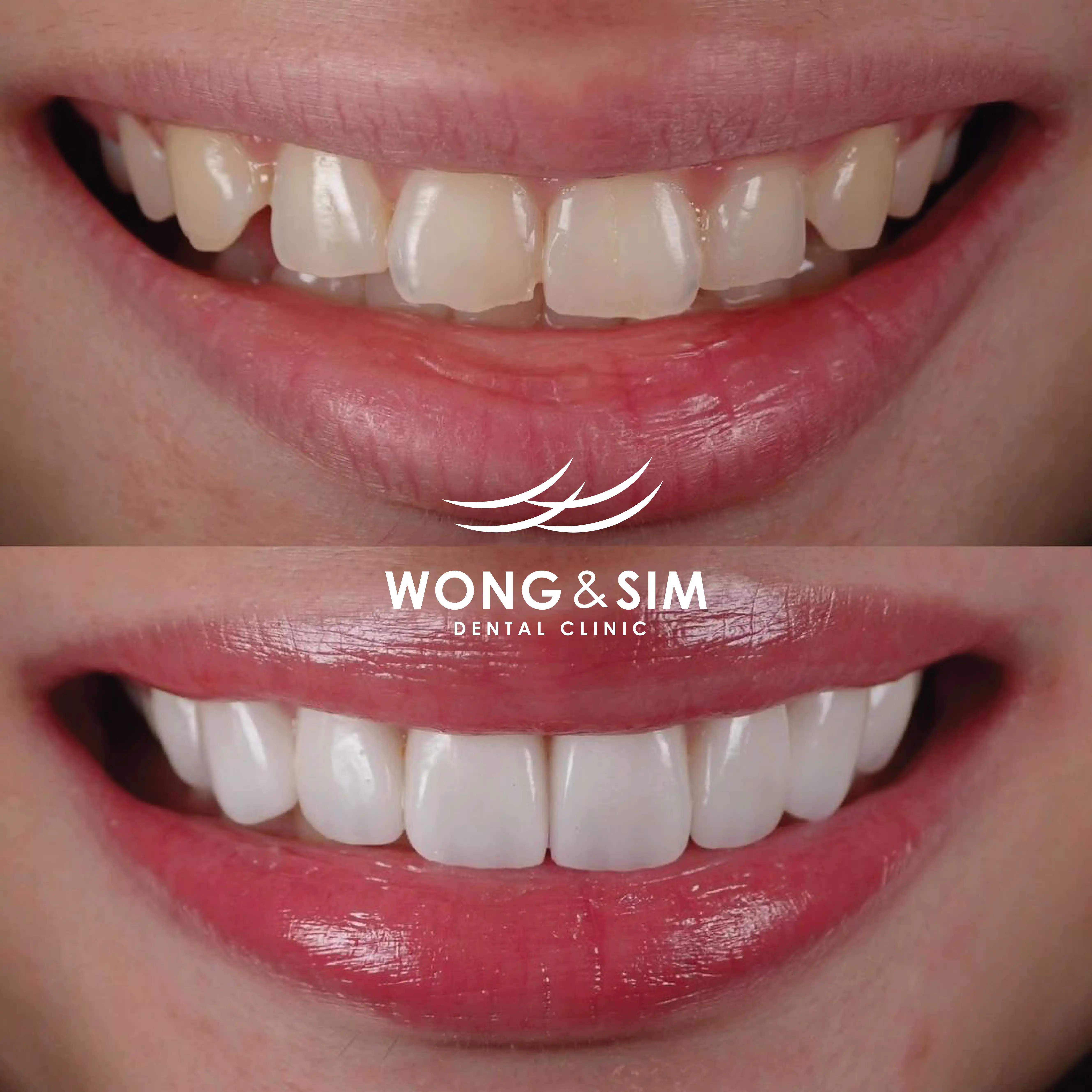 Patient 3 - Dental Implants Before and After